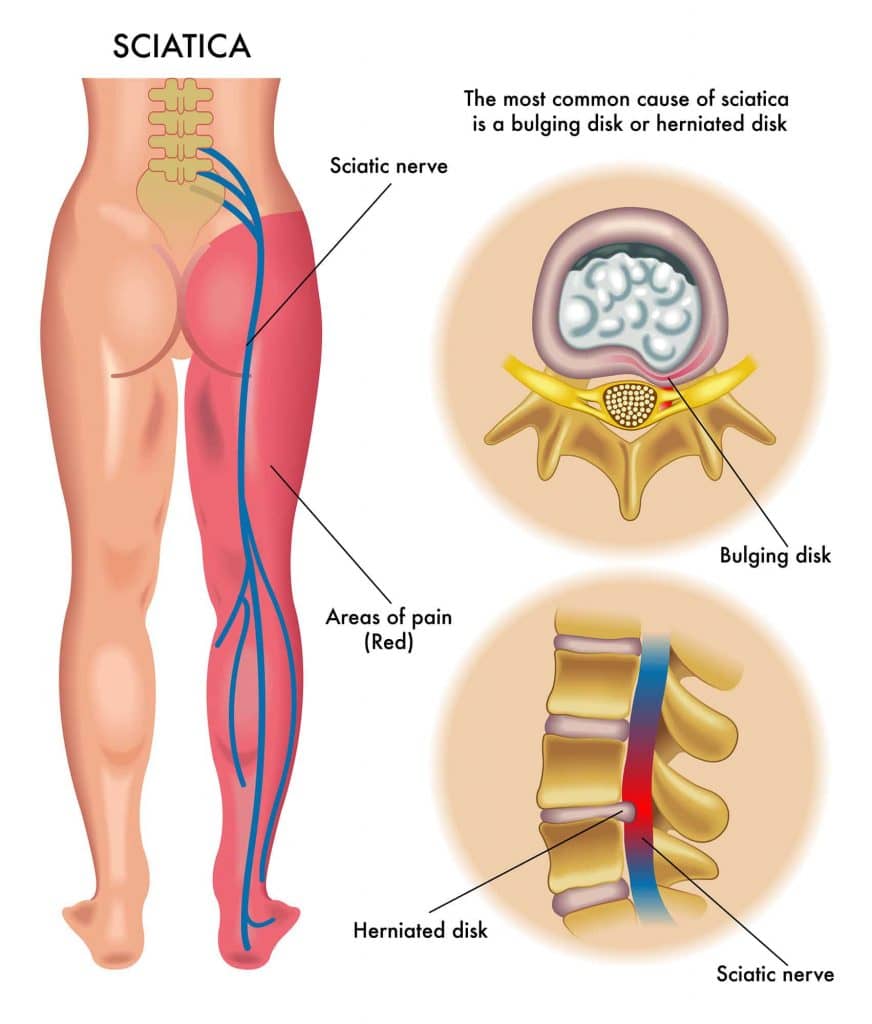 sciatica nerve anatomy