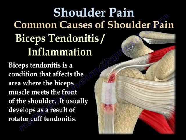 shoulder pain - common causes